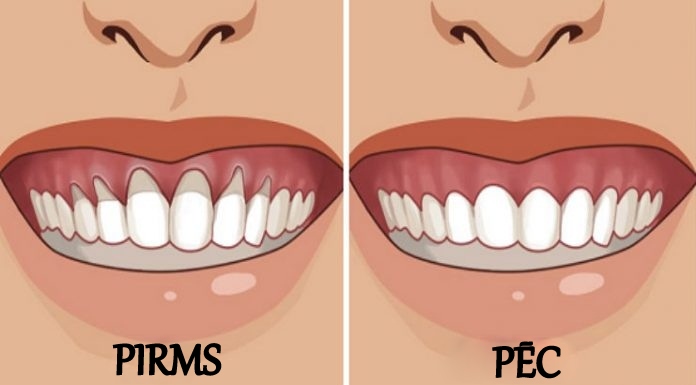 Jūs esat pamanījuši, ka zoba kakliņš un sakne ir atsegti? Nekavējoties uzsāciet ārstēšanu – 6 dabiskas receptes!