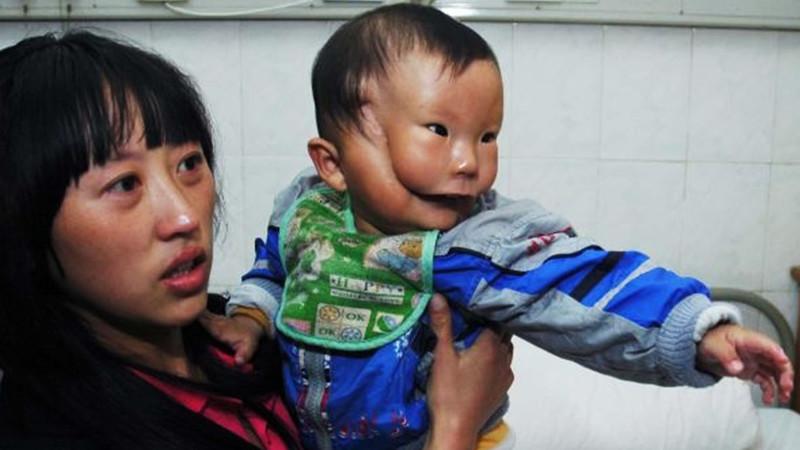 Zēns ar ”divām sejām”: 8 gadus vecais zēns no Ķīnas ar ļoti retu pataloģiju
