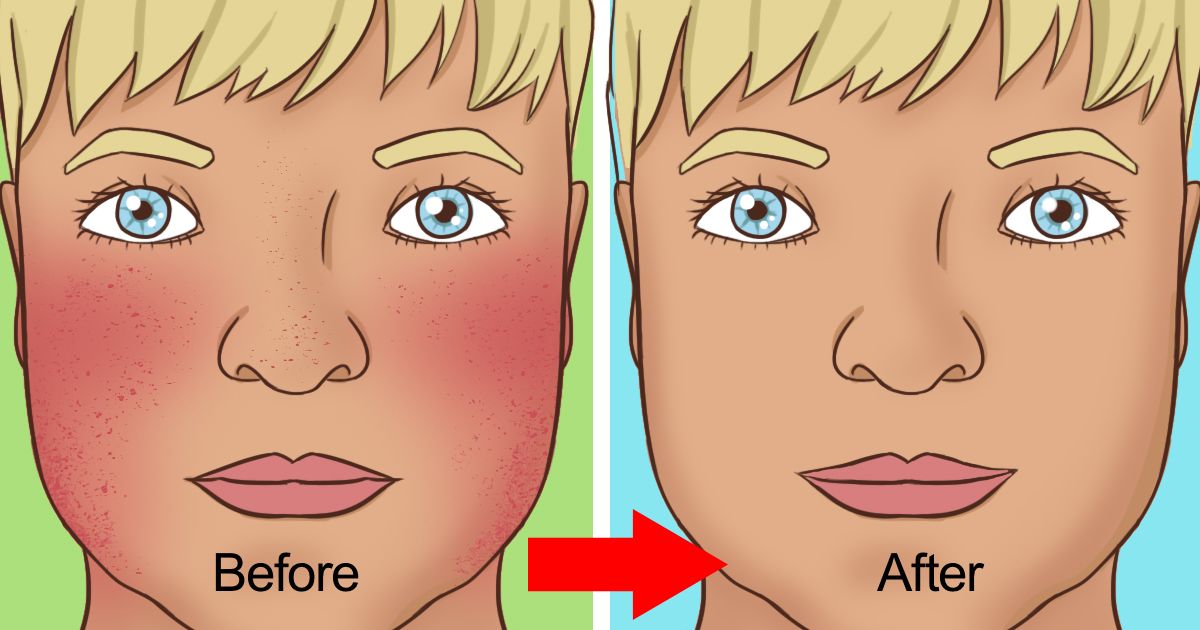 8 dabiski veidi, kā ārstēt rozāciju – sejas apsārtumu