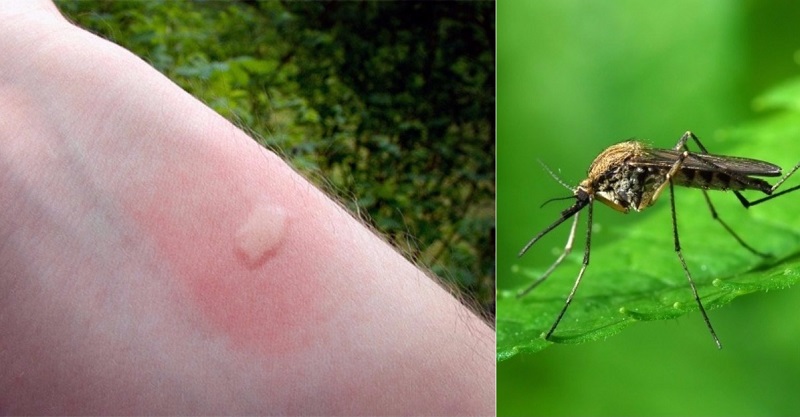 Kā atšķirt kukaiņa kodumu no nopietnas saslimšanas? Nosaki ar neapbruņotu aci