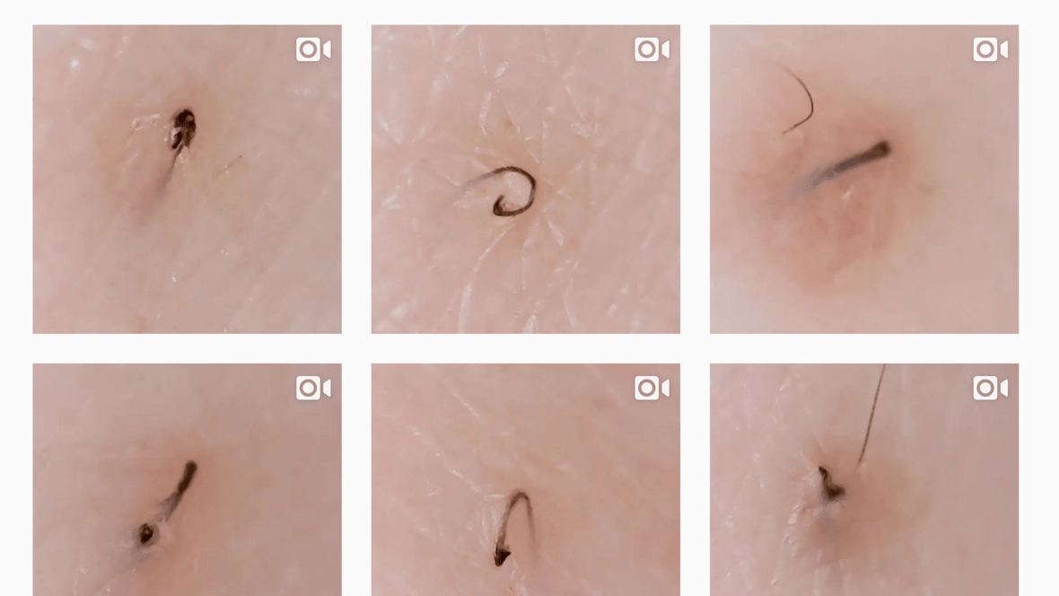 Instagramā ārkārtīgi populārā kļuva lapa, kurā redzami ieaugušo matiņu izņemšanas video (līdzīgi kā pumpu spiešanas video)