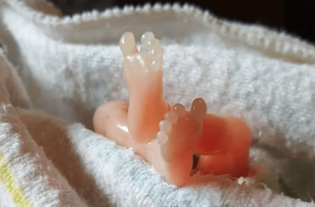 14 nedēļas veca mazuļa foto, pēc spontānā aborta, ļoti strauji izplatījās internetā