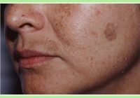 Slavens dermatologs parādīja, kā atbrīvoties no brūnajiem pleķiem uz sejas ādu ar šo vienkāršo triku!