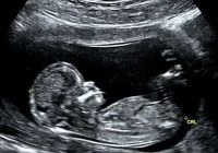 Zinātnieki: nedzimušie bērni sajūt sāpes aborta laikā jau no 12. nedēļas. Bail vien iedomāties…