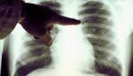 Plaušu vēža pacientiem veltīts pasākums